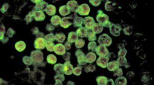 کراچی نے 2025 کی چوتھی نیگلیریا کی موت کی اطلاع دی